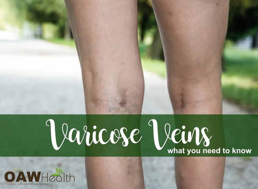 Varicose Veins - What you Need to know - OAWHealth